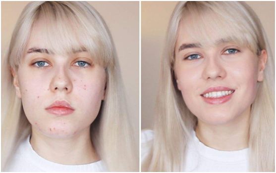 一撕一帖痘痘“隐形”，睡前贴一片，一觉醒来痘痘熟了