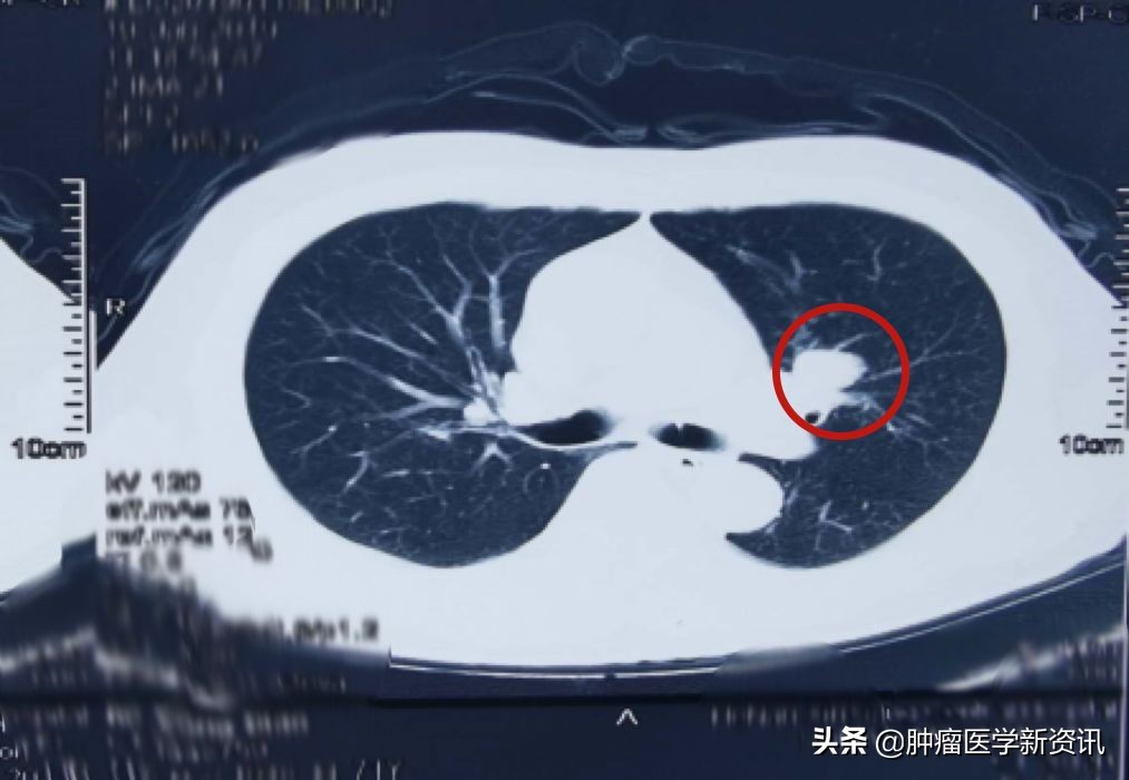 肺癌早期的6个信号中医治癌,肺癌正确的抗癌方法