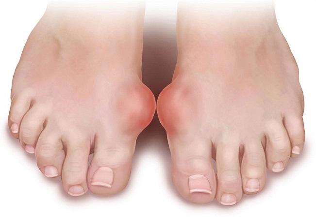 治痛风降尿酸记住这10点,运动排汗痛风