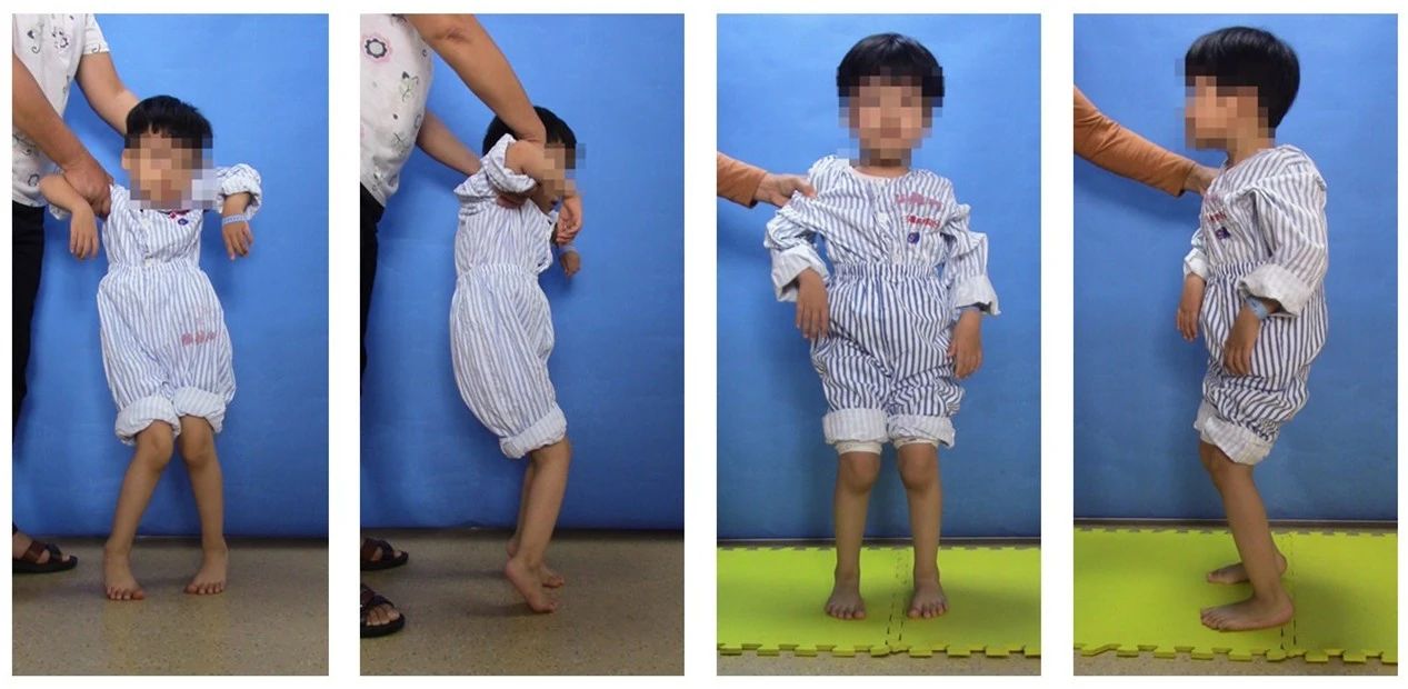 手术康复一体化,脑瘫康复训练10个方法图片