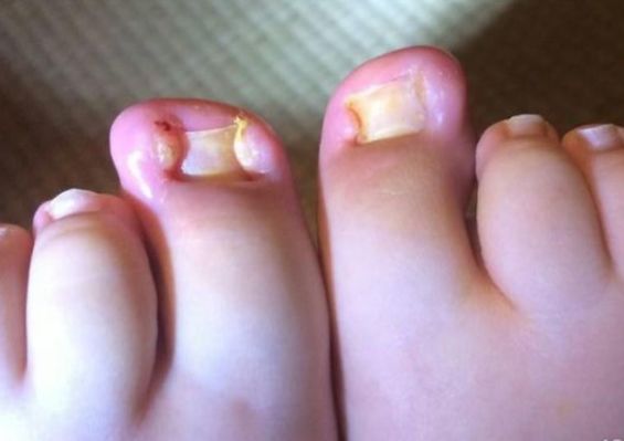 甲沟炎拔过指甲后怎么预防,脚趾盖掉了如何预防甲沟炎