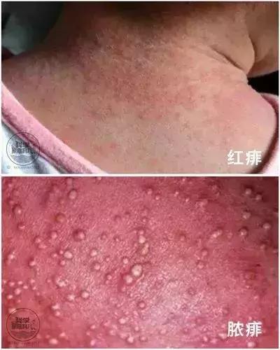 娃身上出了荨麻疹怎么办,娃儿有皮疹怎么止痒