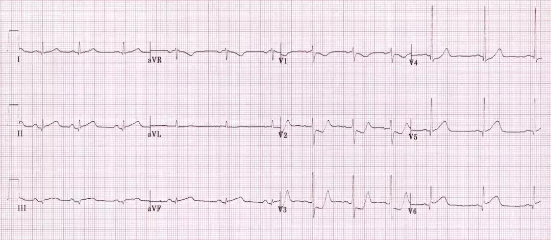 心电图和心脏彩超以哪个为准,心电图和心脏超声是一样吗