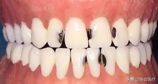 刷完牙用牙线清理牙垢多余吗,刷牙只能清洁70%的牙齿