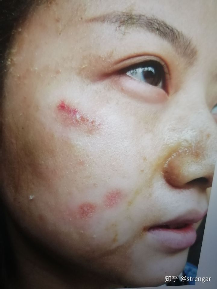 陈金西细胞种植可靠吗,陈金西细胞再生技术疤痕修复