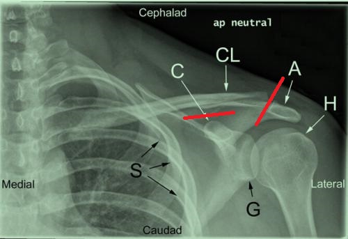 肩锁关节脱位治疗,肩锁关节脱位