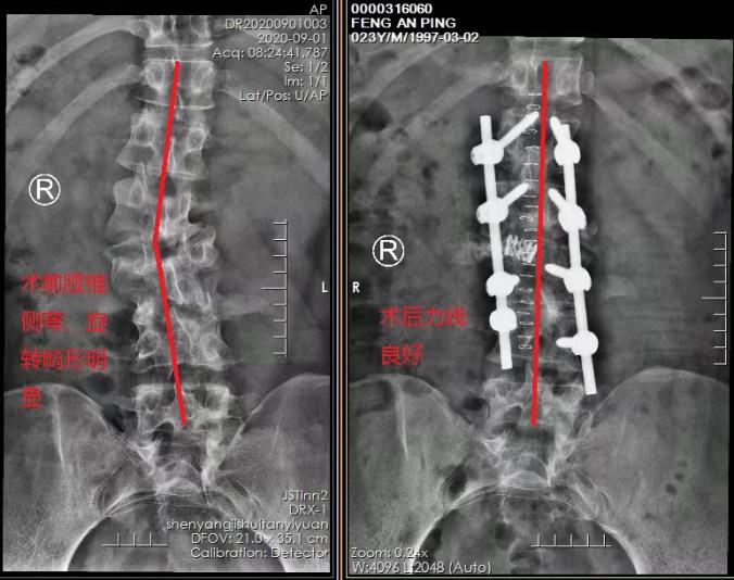 北京积水潭医院骨科脊柱侧弯手术,积水潭医院脊柱微创手术费用