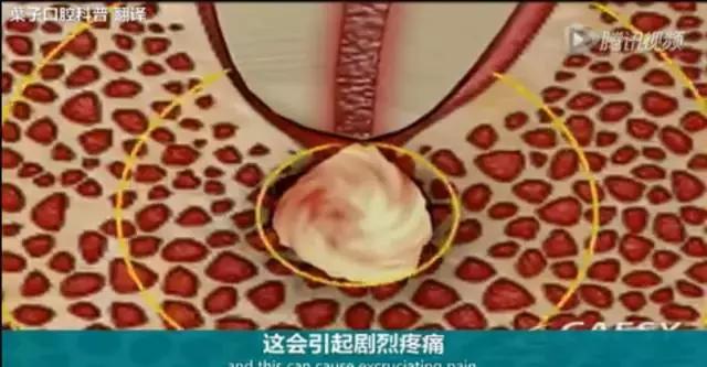 牙龈反复鼓包流脓是牙齿坏了吗,一上火牙龈就鼓包