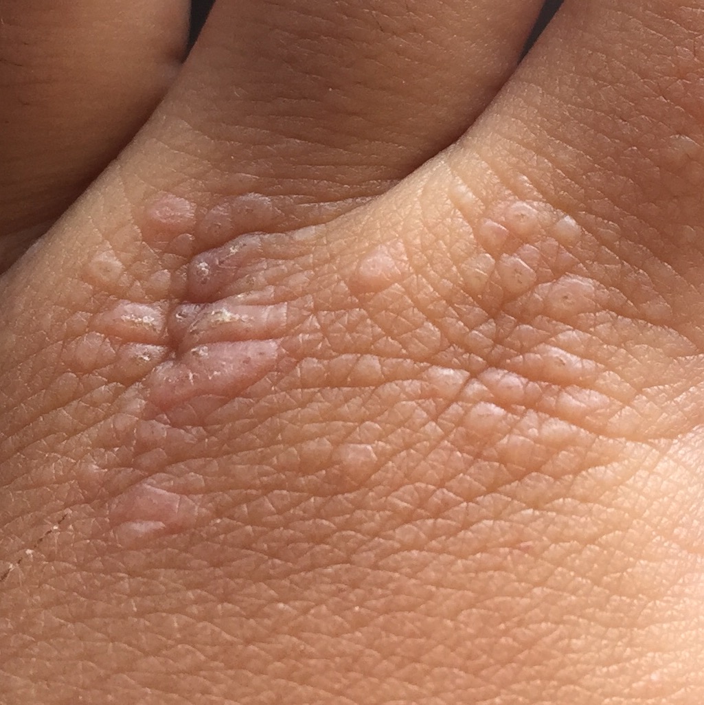 皮肌炎或多发性肌炎的诊断标准,成人皮肌炎与儿童皮肌炎区别