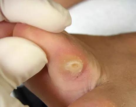 鸡眼是怎样形成的,鸡眼是怎么形成的该怎么解决