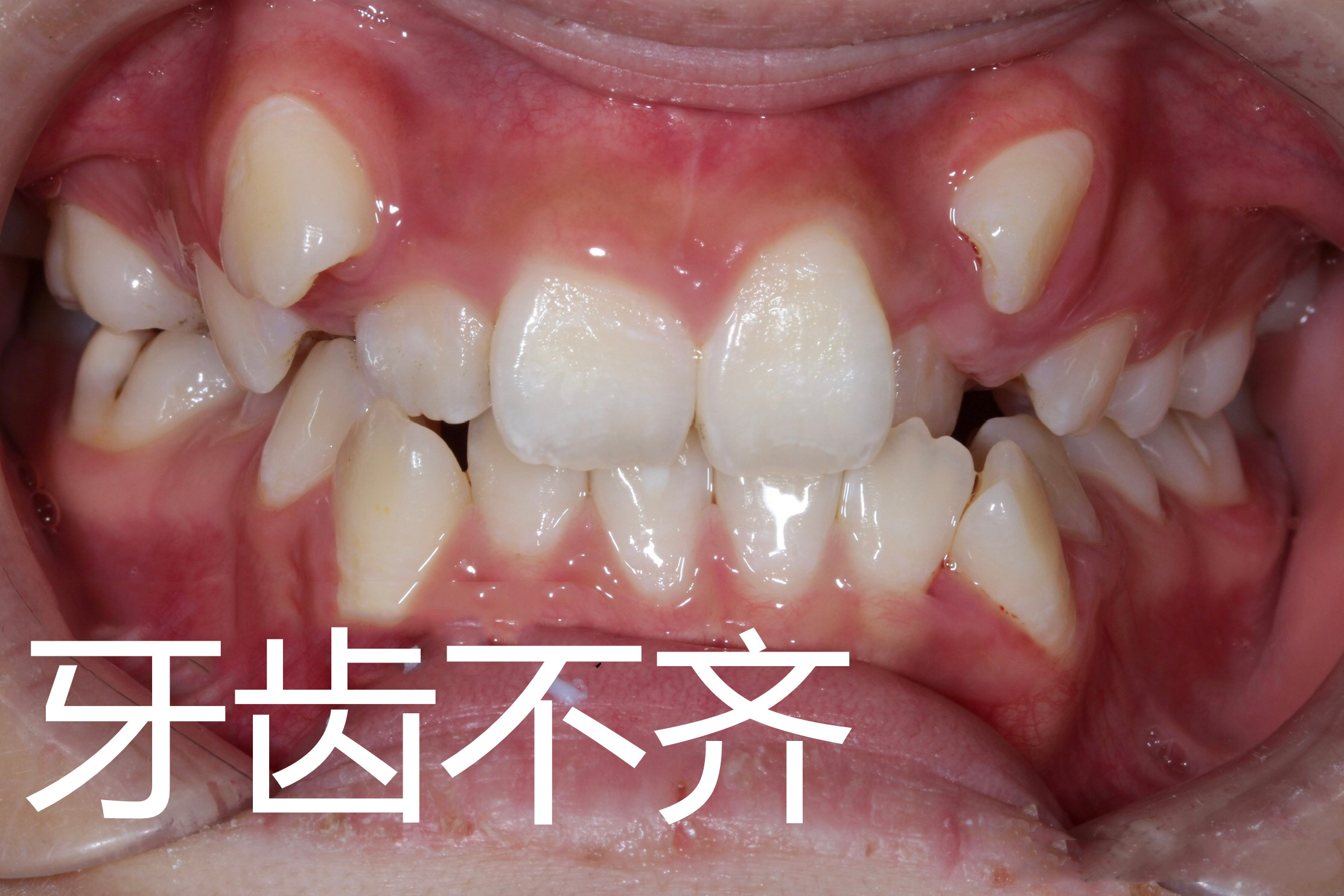 30岁还可以牙齿矫正吗,30岁牙齿矫正一般多少钱