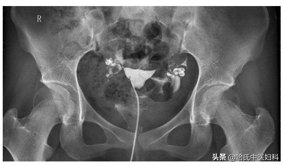 29岁输卵管堵塞怀孕,结婚流产一回会输卵管堵吗