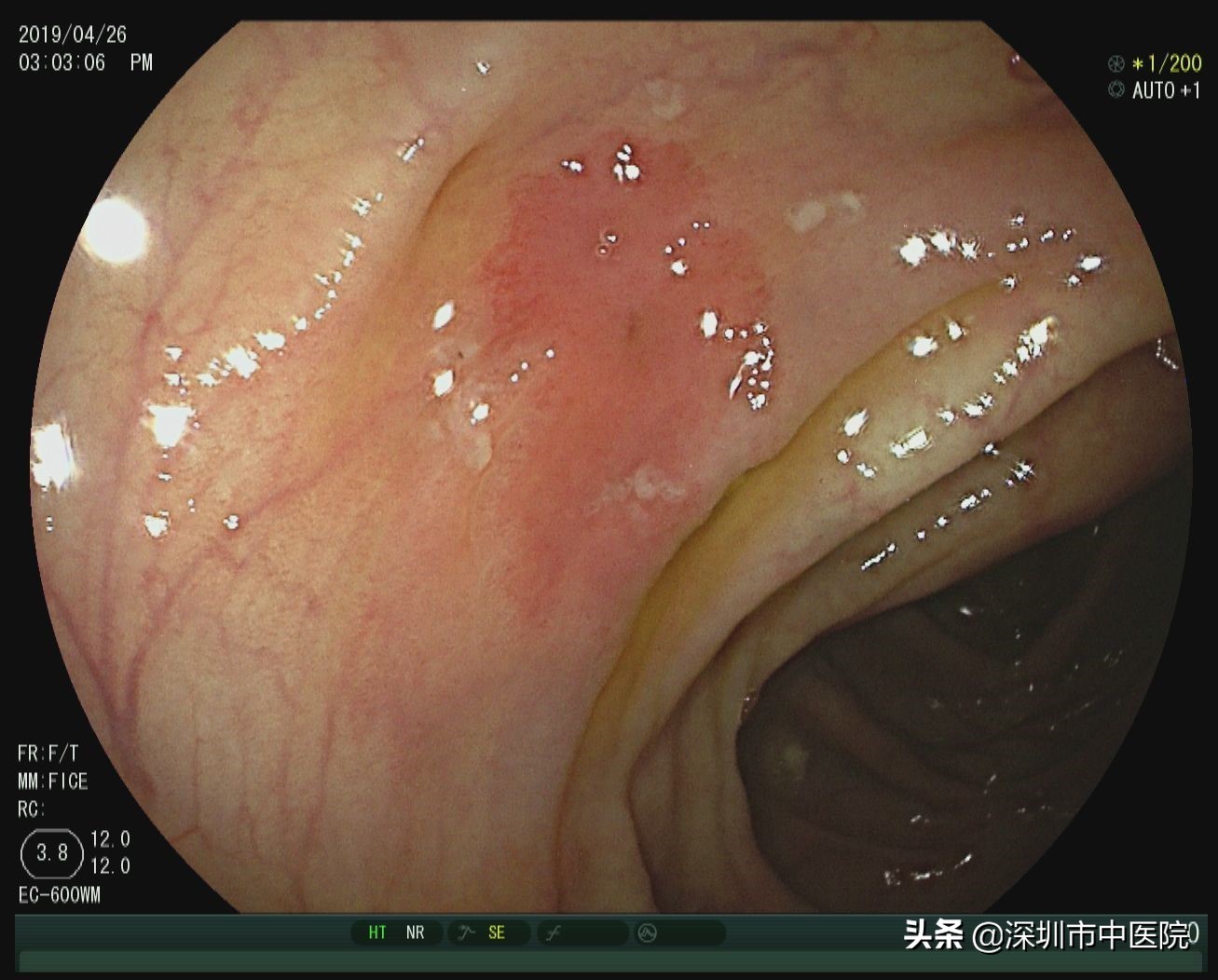 这个神器让肠道“违建”无处遁形！全国首套在深圳启用