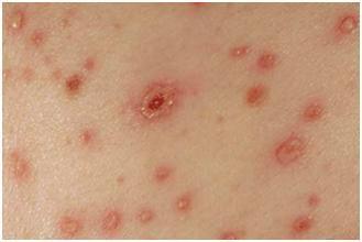 乖乖女高烧起红疹，确诊后痛哭不已，提醒：她的坏习惯很多人都有