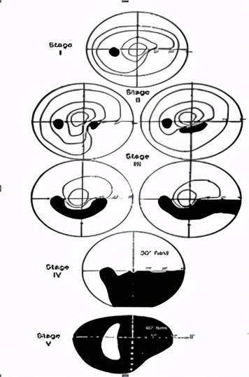青光眼杯盘比增大机制,杯盘比大于多少怀疑青光眼