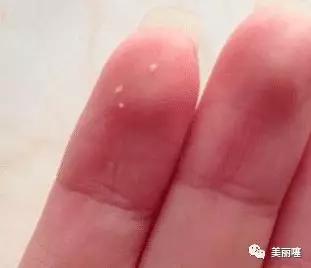 鼻翼凸起的白色小肉粒怎么去除,下巴和鼻子的小颗粒怎么去除