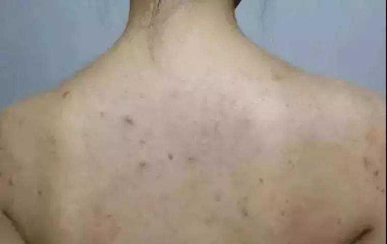 痘痘留下的黑色素可以自己消失吗,瘙痒异味用什么洗