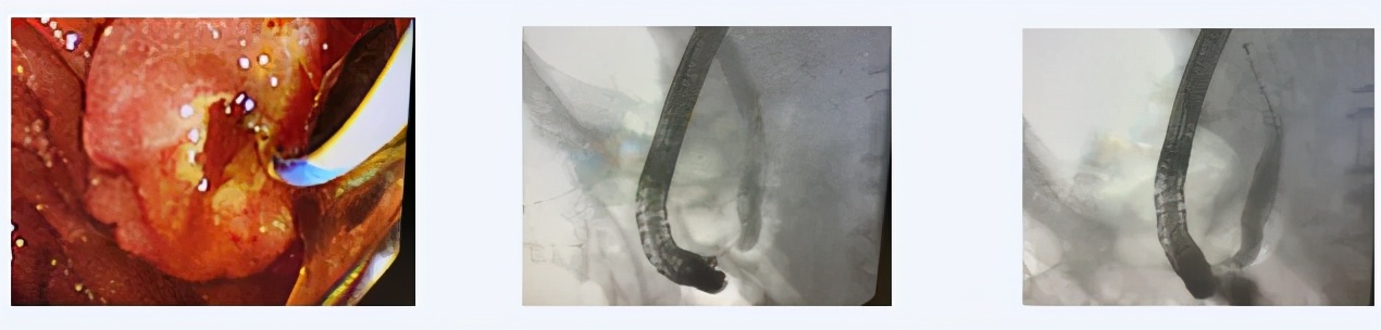 西青医院普通外科医疗团队连续运用ERCP微创技术治疗高危难病患