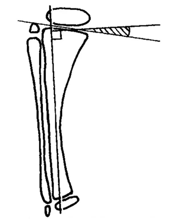膝关节x线片可以查出啥,膝关节间隙x线测量方法