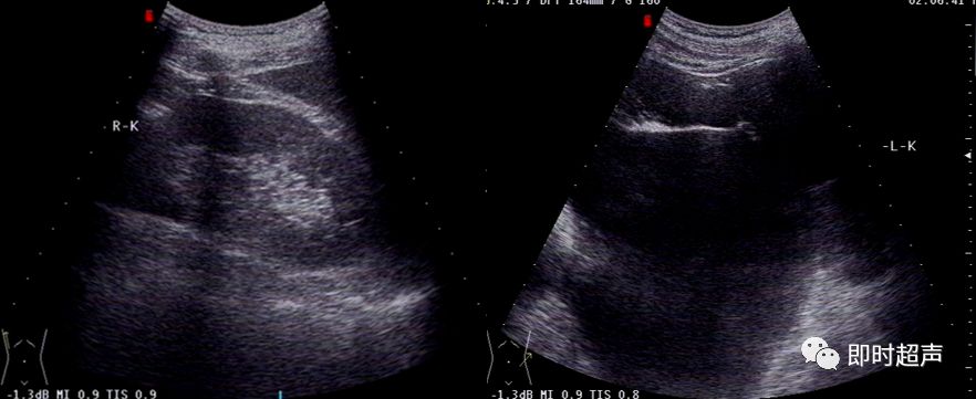 膀胱超声图解大全,膀胱超声解剖及常见病变超声表现