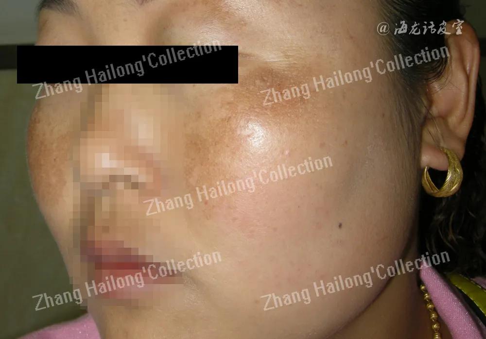 褐青斑怎么治疗最有效果,褐青斑有哪些治疗方法