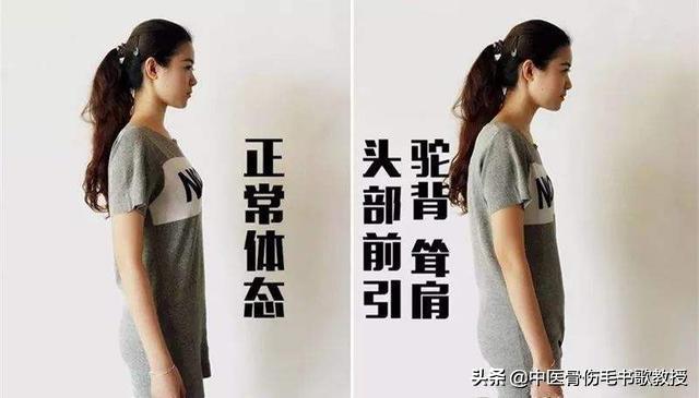 驼背如何矫正最快最有效动作,驼背怎么矫正最快的方法