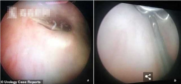 14岁男生把9厘米缝衣针插入尿道，痛苦三天去就医，网友：爽吗？