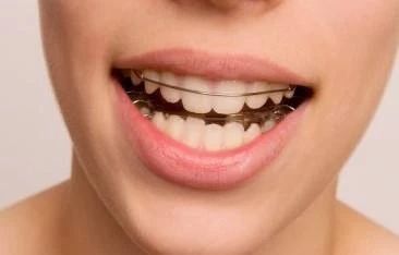 牙齿矫正后隐形保持器佩戴方法,牙齿矫正保持器必须24小时佩戴吗