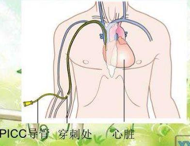 不可不知道的PICC置管后的居家护理