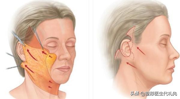 剥离拉皮提拉紧致,拉皮提拉紧致抗皱手术