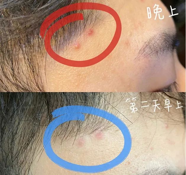 有效祛痘印的痘痘贴,祛痘痘的药膏明星