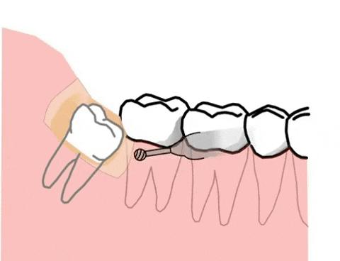 智齿冠周炎疼痛最快缓解办法,智齿冠周炎疼痛难忍怎么办