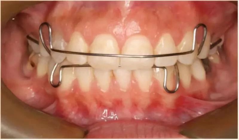 南宁牙齿矫正的每一个详细步骤,儿童的牙齿矫正的步骤