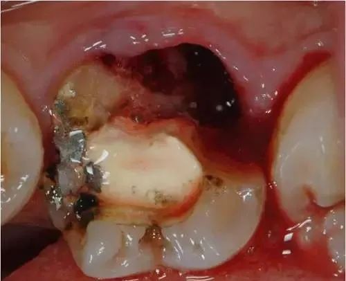 已经有牙洞了怎么根管治疗,牙髓腐烂坏死再做根管治疗会痛吗