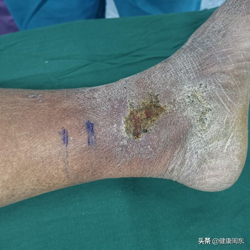 下肢动脉粥样硬化闭塞中药针剂,下肢动脉硬化闭塞症插管溶栓治疗