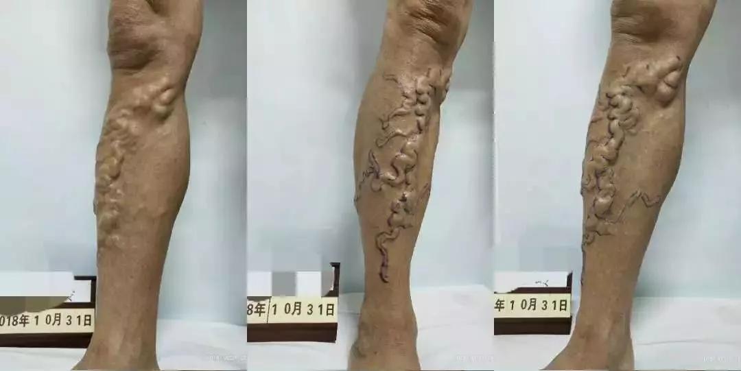 青岛第八人民医院义诊,山东青岛市立医院治疗静脉曲张