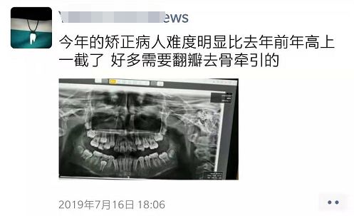埋得越深,分手费越高——你所不知道的拔智齿收费依据