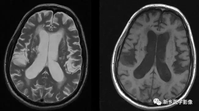 什么引起成人脑室扩大,哪些病可以导致左侧脑室增宽