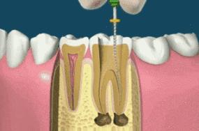 牙齿的普通治疗与根管治疗,根管治疗最严重的牙齿