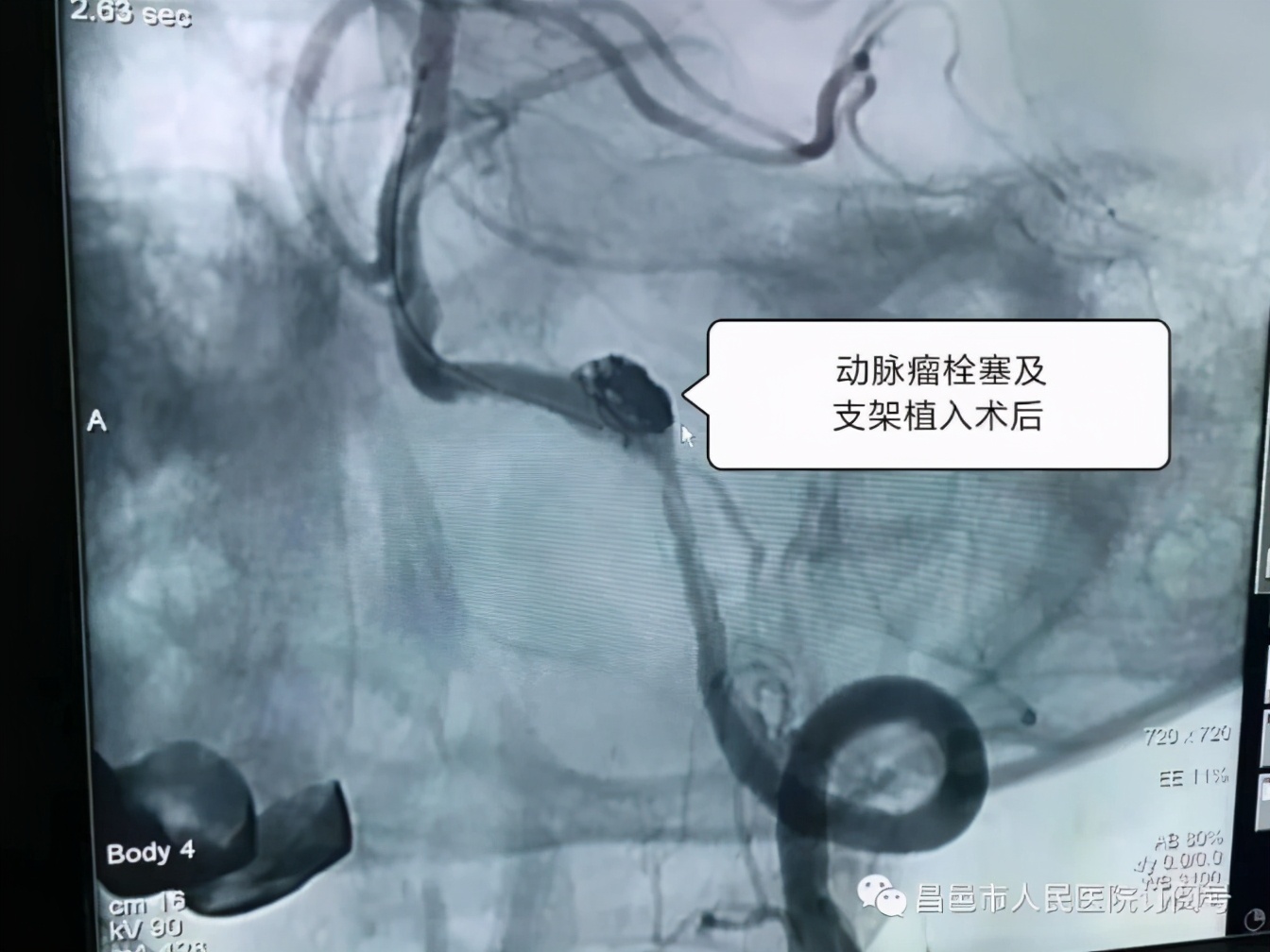 1mm颅内动脉瘤介入栓塞术成功率,脑动脉瘤栓塞手术成功