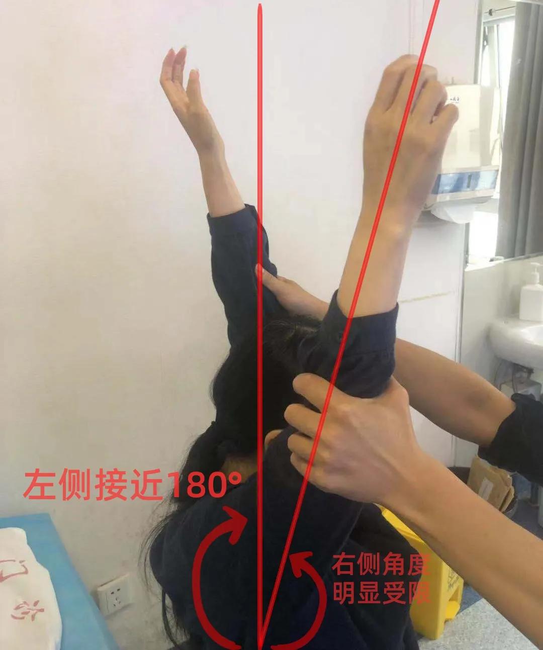 肩周炎锻炼过度会加重吗,肩周炎需要注意哪些问题