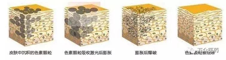 怎样预防老年斑及去除老年斑,怎么能去掉老年斑和预防老年斑