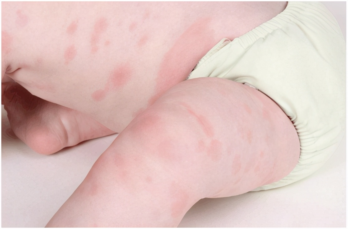 春天儿童疹子,春季儿童高发哪种疹子