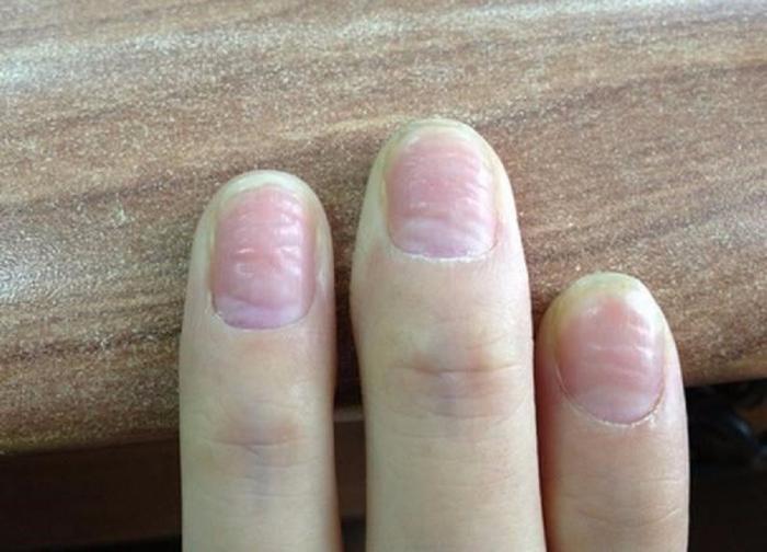 指甲易中空应该补充什么营养,手脚指甲凹凸不平是缺少什么营养