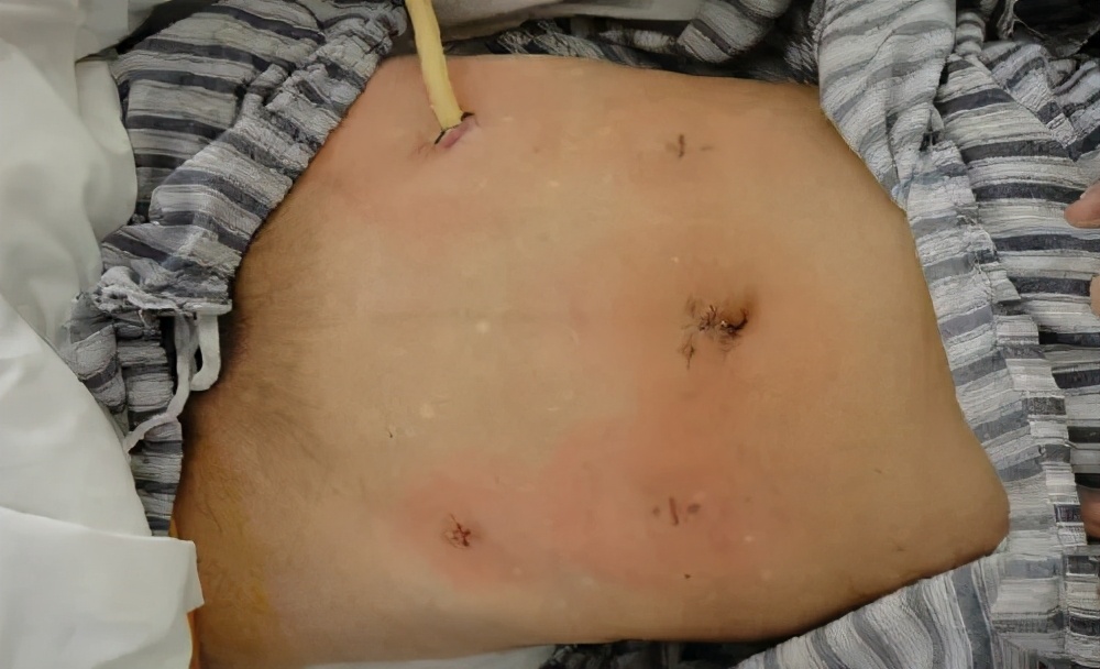 大肠癌切除后腹胀,大肠癌腹痛是牵扯疼吗