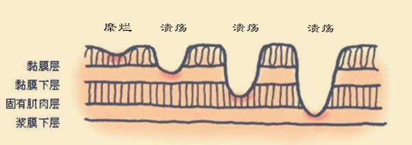 糜烂性胃炎严重吗怎么回事,胃食管反流和糜烂性胃炎治疗方法