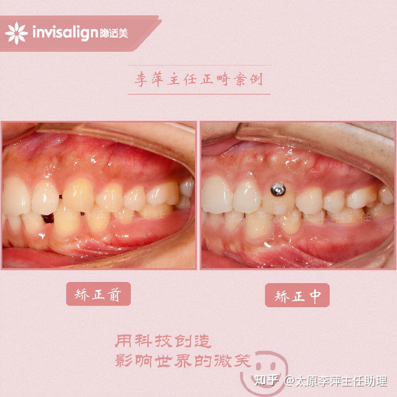 太原牙齿矫正靠谱吗,太原成人隐形牙套牙齿不齐