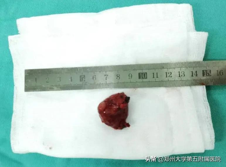 鼻咽癌导致颈部包块是早期吗,颈部包块怎么治疗最好