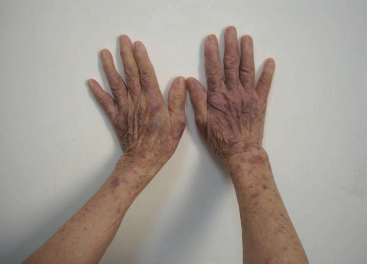 2023红斑狼疮最新研究,中国治疗红斑狼疮科学新进展