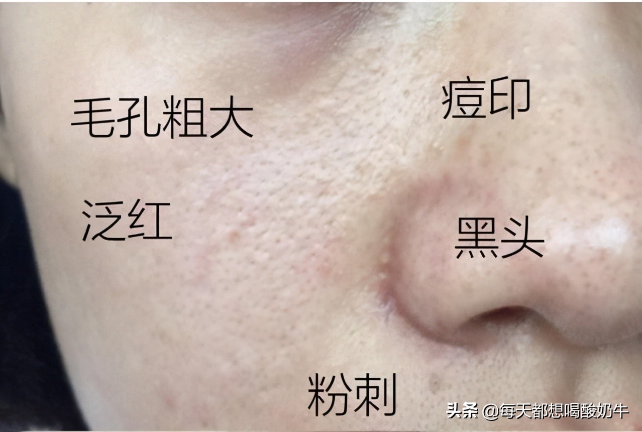 脸干长痘毛孔粗红血丝用什么修复,脸部泛红毛孔大怎么改善